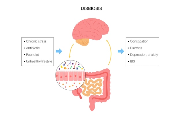 Darm-Hirn-Verbindungsdysbiose und Mikrobiom Normale und abnormale Mikrobiota