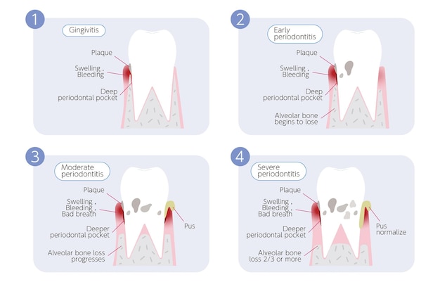 Vektor darstellung des fortschreitens der parodontalerkrankung in 4 stadien