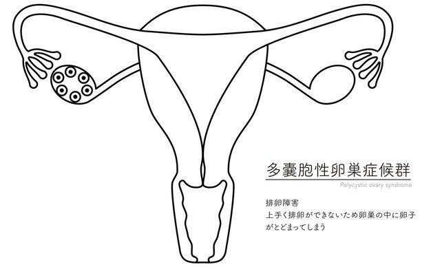 Vektor darstellung des syndromes der polycystischen eierstöcke, der ovulationsstörung, der anatomie der gebärmutter und der eierstocke