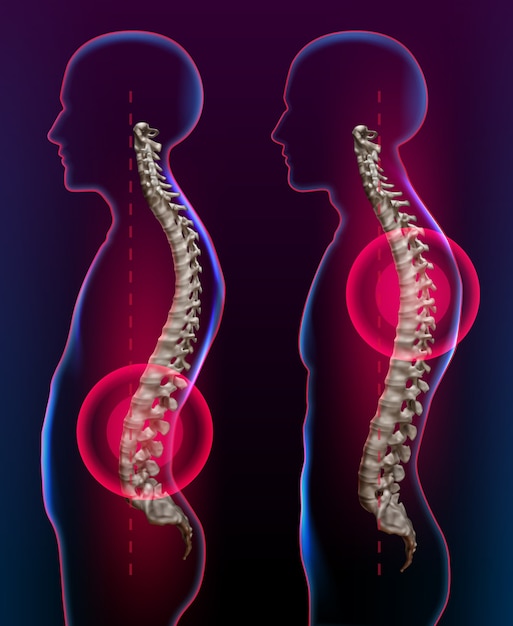 Darstellung von Rückenschmerzen als medizinisches Gesundheitskonzept für die Gesundheit und Therapie der Wirbelsäule
