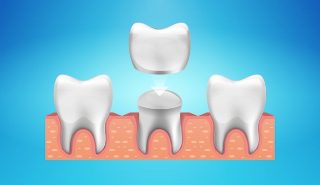 Dental crown restoration im realistischen stil.