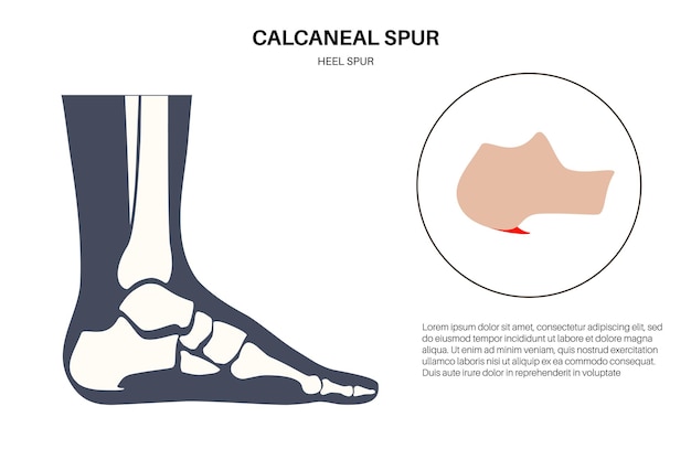 Vektor diagnose und behandlung von fußproblemen in der podologie-klinik fesselknochenwachstum aus der fesselknöchel tuberosität knöchelschmerzen und schwellungen röntgenuntersuchung der füße vektor-illustration