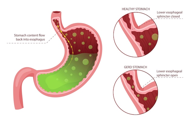 Diagramm der gastroösophagealen Refluxkrankheit