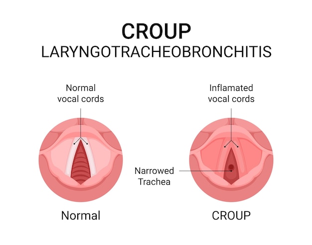 Diagramm der Krupp-Laryngotracheobronchitis