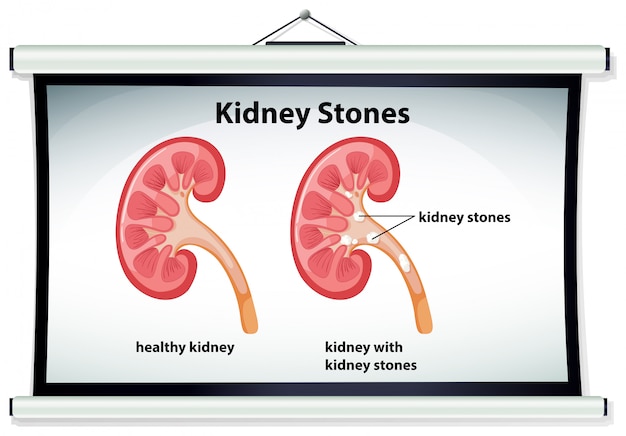 Diagramm mit nierensteinen