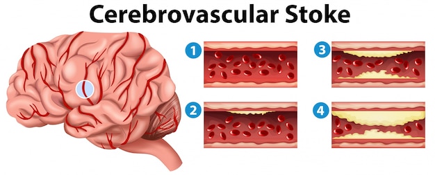 Diagramm zeigt stadien des zerebrovaskulären schlaganfalls