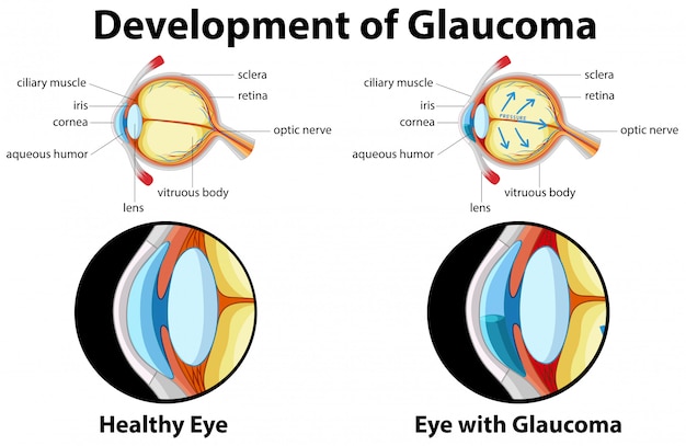 Vektor diagramm zur entwicklung des glaukoms