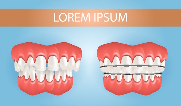 Diastema und zahnspange mit kreuzbisszähnen