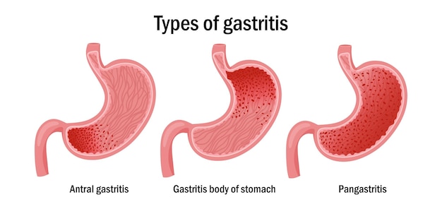 Drei arten von gastritis-illustrationen
