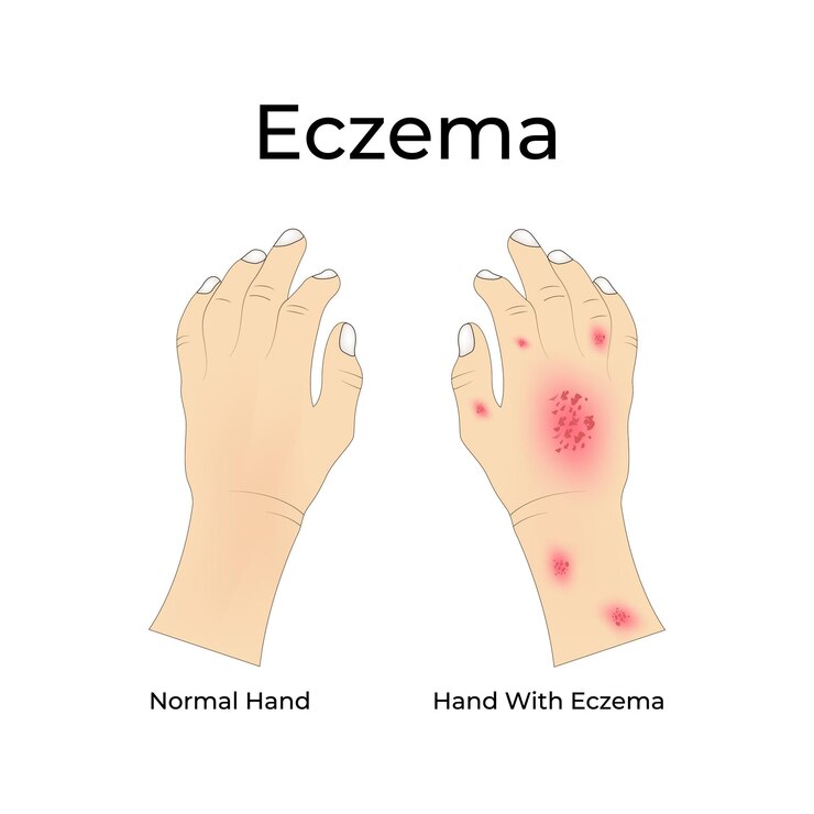Vektor eczema auf den händen design-vektor-illustration