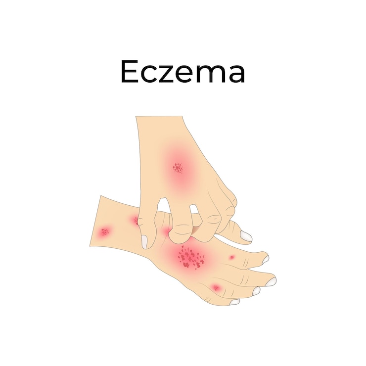 Vektor eczema auf den händen design-vektor-illustration