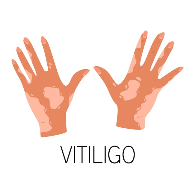 Eine illustration von händen mit vitiligo. welt vitiligo-tag. hautkrankheiten, pigmentstörungen.