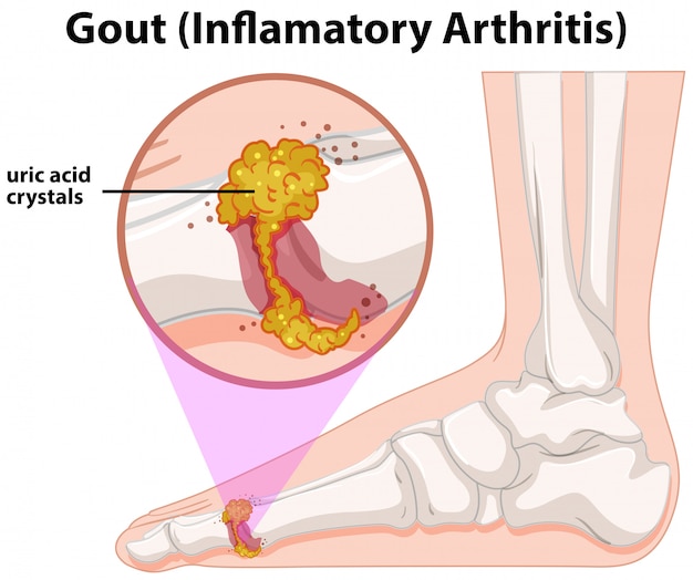 Vektor eine medizinische menschliche anatomie-gicht