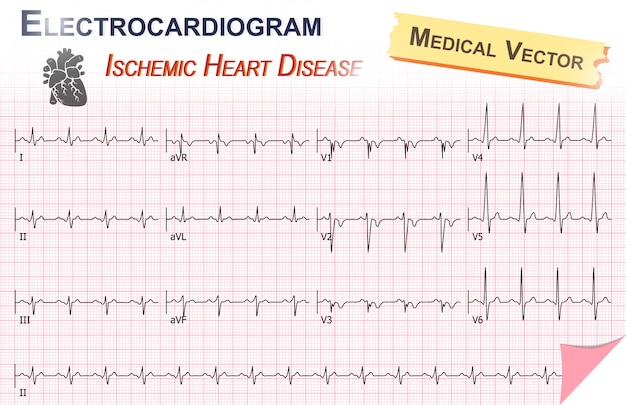 Elektrokardiogramm der ischämischen herzkrankheit (myokardinfarkt)