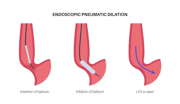 Endoskopische pneumatische dilatation obere endoskopie minimalinvasiver eingriff störung der speiseröhre therapie bei achalasie ballon zerstört die muskelfasern im geschlossenen unteren ösophagussphinkter