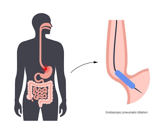 Endoskopische pneumatische dilatation obere endoskopie minimalinvasiver eingriff störung der speiseröhre therapie bei achalasie ballon zerstört die muskelfasern im geschlossenen unteren ösophagussphinkter