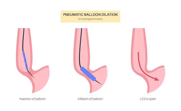 Vektor endoskopische pneumatische dilatation obere endoskopie minimalinvasiver eingriff störung der speiseröhre therapie bei achalasie ballon zerstört die muskelfasern im geschlossenen unteren ösophagussphinkter
