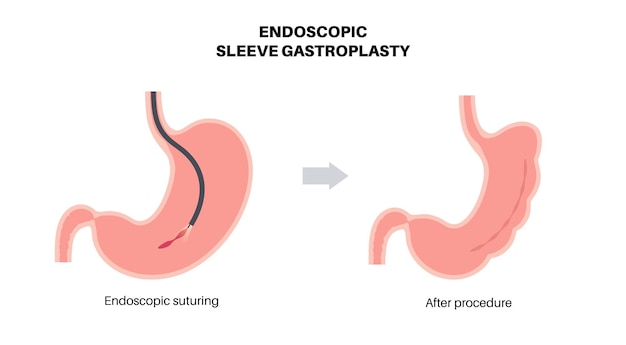Vektor endoskopische sleeve-gastroplastie magenchirurgie gewichtsverlust magenverfahren laparoskopie-konzept übergewichtsproblem im menschlichen körper vor und nach der operation flache vektormedizinische illustration