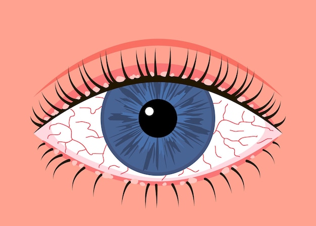 Entzündetes krankes menschliches auge blepharitis allergiesymptom rote venen augenkrankheit allergische konjunktivitis