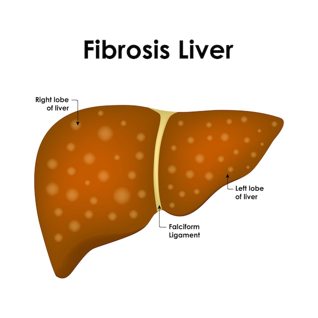 Fibrose Leberanatomie Rechter und linker Leberlob von Falciform Ligament Vector Illustration