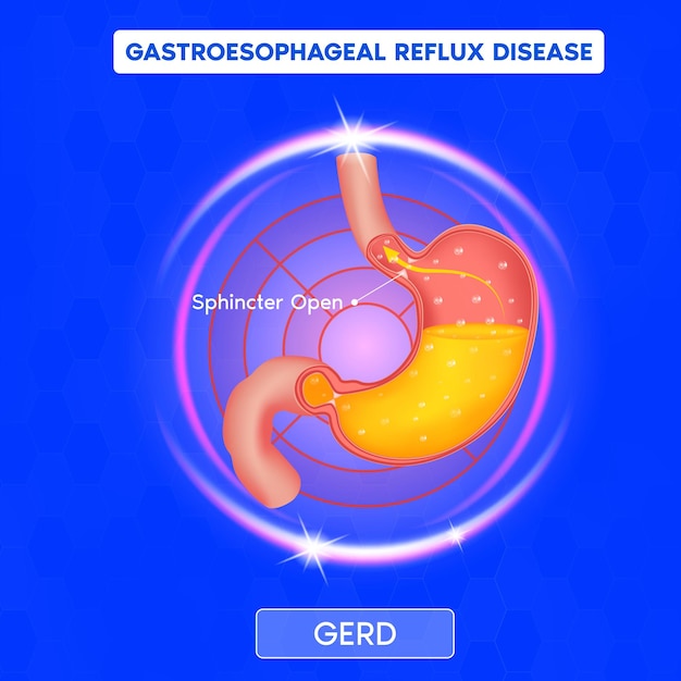Vektor gastroesophageale refluxkrankheit