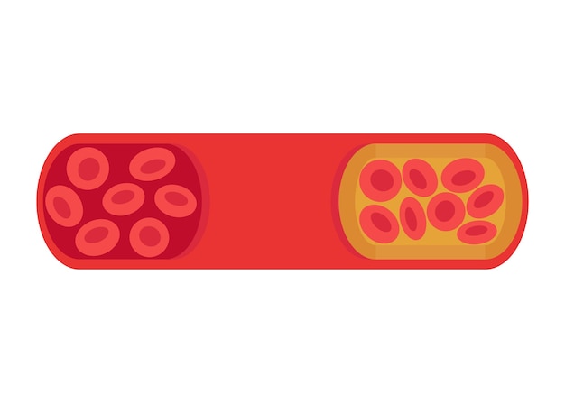 Vektor gefäßwechsel von normaler zu cholesterinblockierter arterie blutgerinnsel thrombus atherosklerotischer plaque