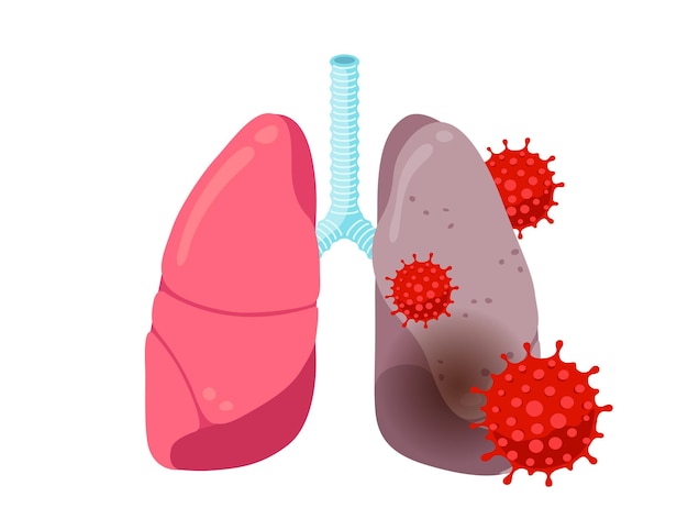 Gesunde und kranke ungesunde Lunge mit Coronavirus-Infektion Inneres Organ des menschlichen Atmungssystems