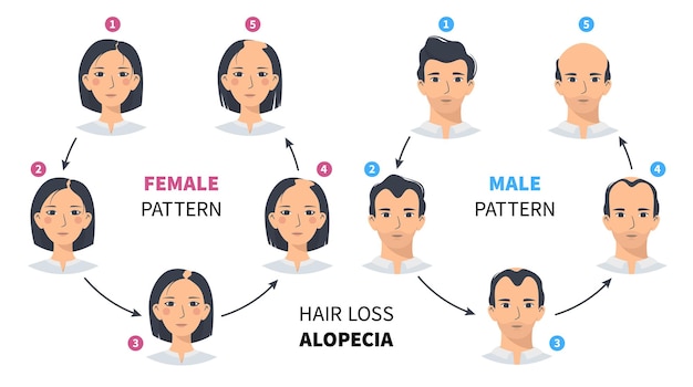 Haarausfall stadien männlicher und weiblicher alopezie kreis infografik und stufen der kahlheit