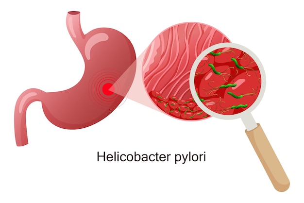 Helicobacter pylori in der magenschleimhaut unter lupe vektor-illustration cartoon-stil weißer hintergrund