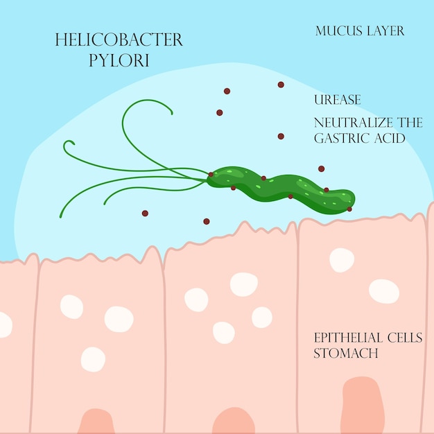 Helicobacter pylori in der schleimhautschicht im magen infografik