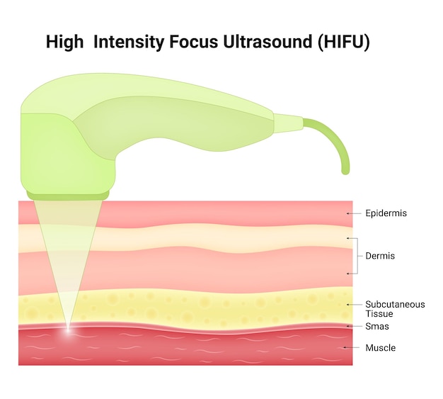 Vektor highintensity focus ultraschall hifu vektor-illustration