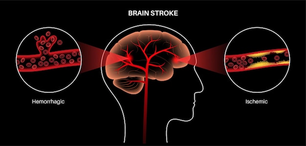 Vektor hirnschlag ischämisch und hämorrhagisch