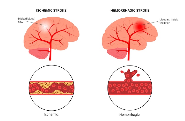 Hirnschlag ischämisch und hämorrhagisch