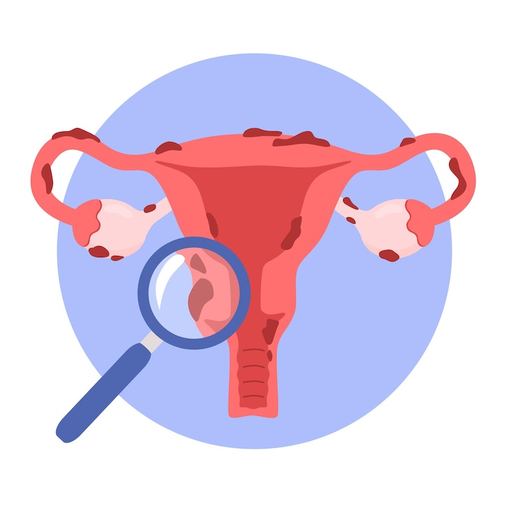 Vektor illustration der gebärmutter und endometriose. frauenkrankheiten, gynäkologische untersuchung.