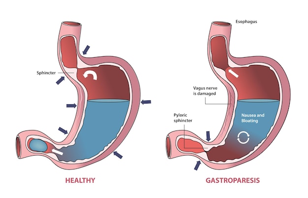 Illustration eines gesunden magen- und gastroparesezustands