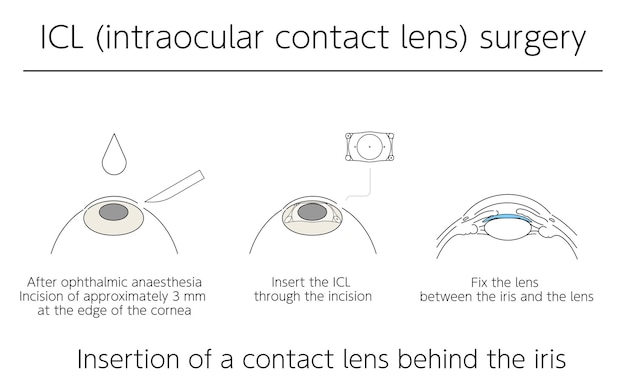 Vektor illustration sehkorrektur mit intraokularen icl-kontaktlinsen medizinische illustration