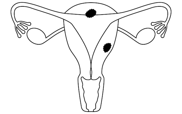 Illustrative abbildungen der anatomie von endometrialkrebs, der gebärmutter und der eierstöcke