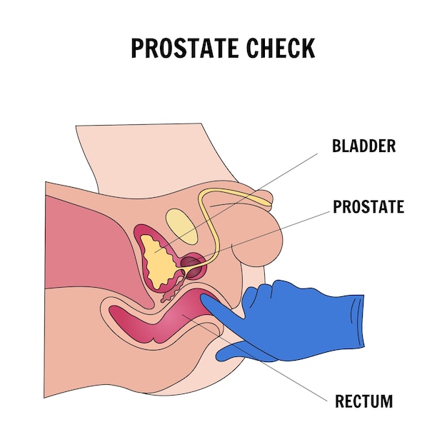 Infografik des Arztes, der die Prostata in der Vektorillustration überprüft