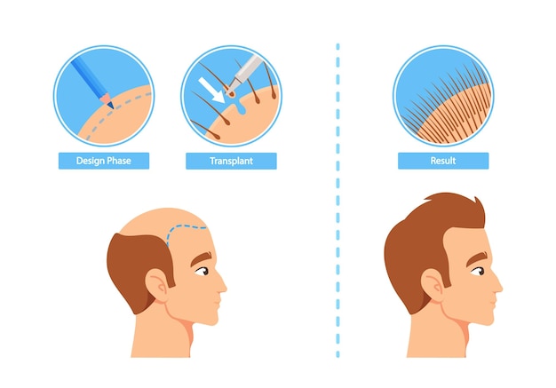 Infografiken zum haartransplantationsprozess, einschließlich designphase der transplantation und ergebnisphasen vor und nach bildern