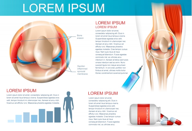 Infographik behandlungsmethode rheumatoide arthritis