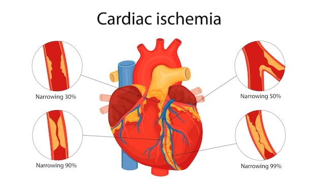 kardiale Ischämie. anatomische Illustration im Cartoon-Stil gezeichnet