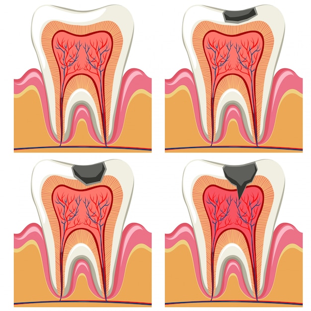 Kariesdiagramm im detail