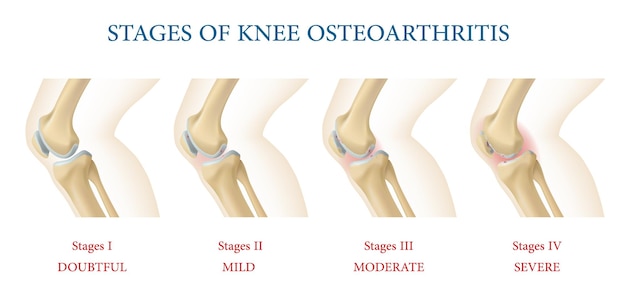 Vektor kniegelenk-osteoarthritis stadien infografiken