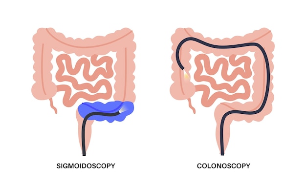 Vektor koloskopie- und sigmoidoskopie-test untersuchung und behandlung des dickdarms erkrankung des dickdarms entzündliche darmerkrankung verstopfung oder inkontinenz magen-darm-medizinischer vektor