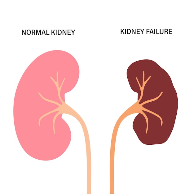 Vektor konzept der nierenerkrankung