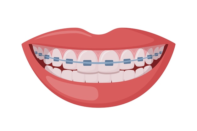 Korrektur-Orthodontik lächelnder weiblicher Mund mit gesunden Zähnen und Zahnspangen
