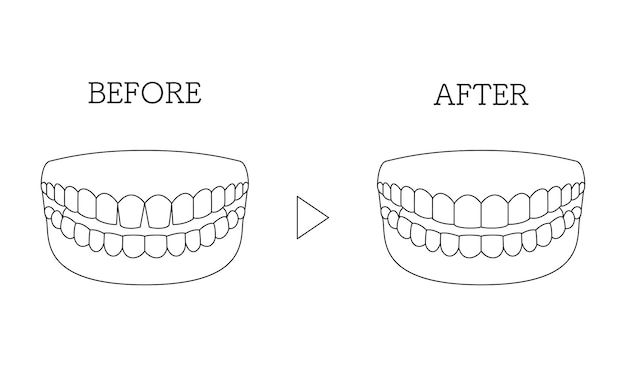 Vektor kosmetische zahnmedizin direktverbindung vor und nach den geöffneten vorderen zähnen