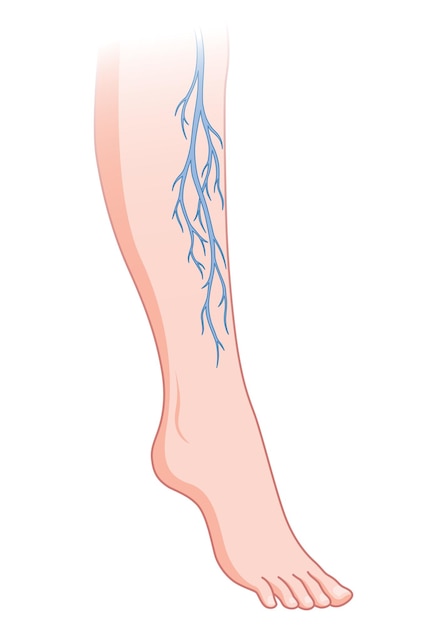 Vektor krampfadern blaues blutgefäß, sichtbar durch die haut, ungewöhnlich geschwollenes bein, diagnose und behandlung von gefäßerkrankungen, medizinische erkrankung der veneninsuffizienz