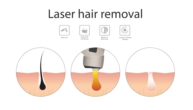 Laser-haarentfernungskonzept mit haut- und haarbereichen. phasen des entfernungsverfahrens. medizinisches diagramm