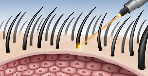 Vektor laser-haarentfernungsverfahren für die schönheit entfernt haare auf zellulärer tiefer ebene. realistische datei